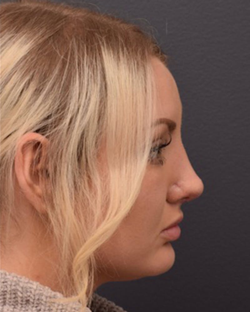 Ultrasonic Rhinoplasty Before & After Gallery - Patient 308011 - Image 2