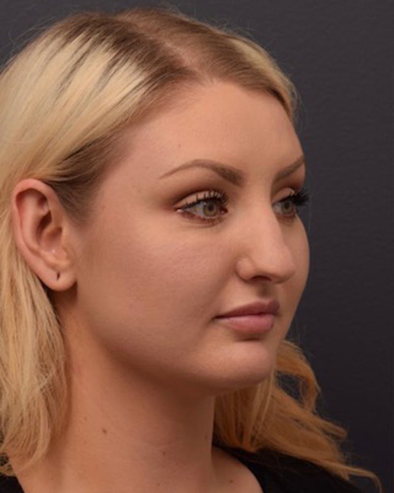 Ultrasonic Rhinoplasty Before & After Gallery - Patient 308011 - Image 5