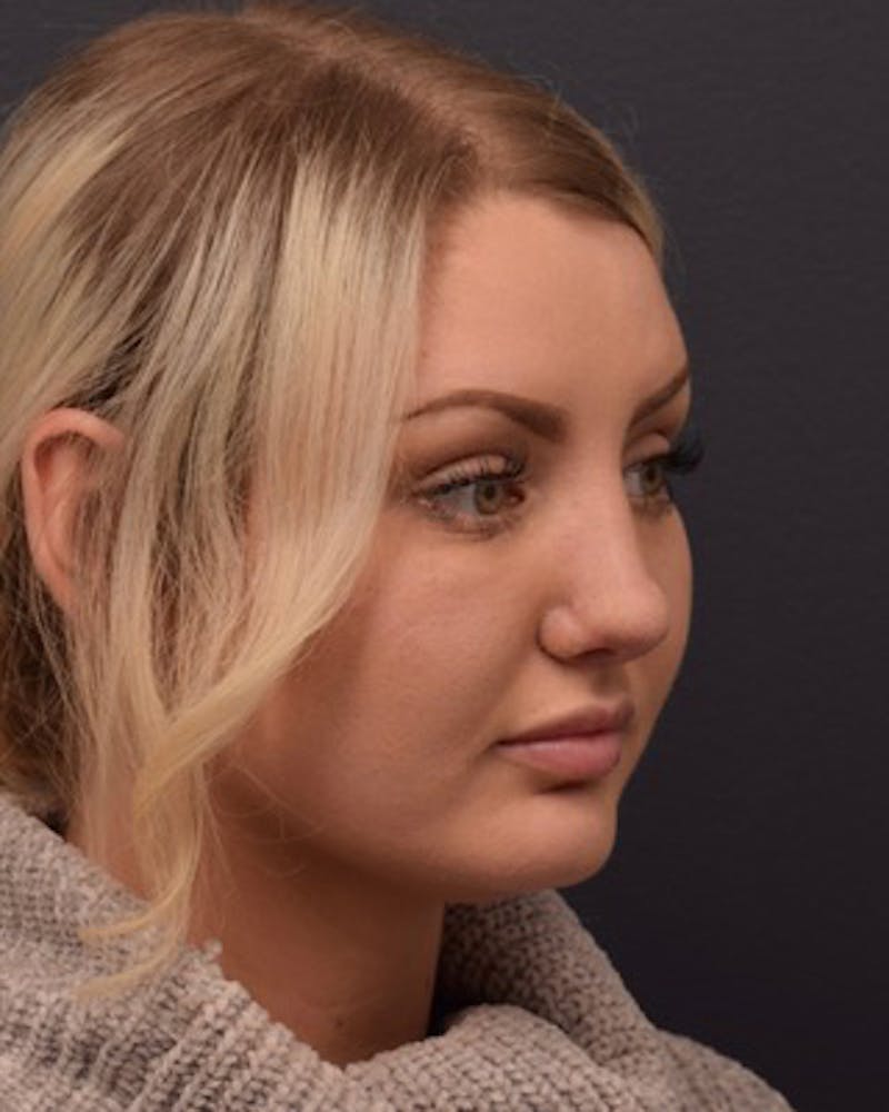 Ultrasonic Rhinoplasty Before & After Gallery - Patient 308011 - Image 6