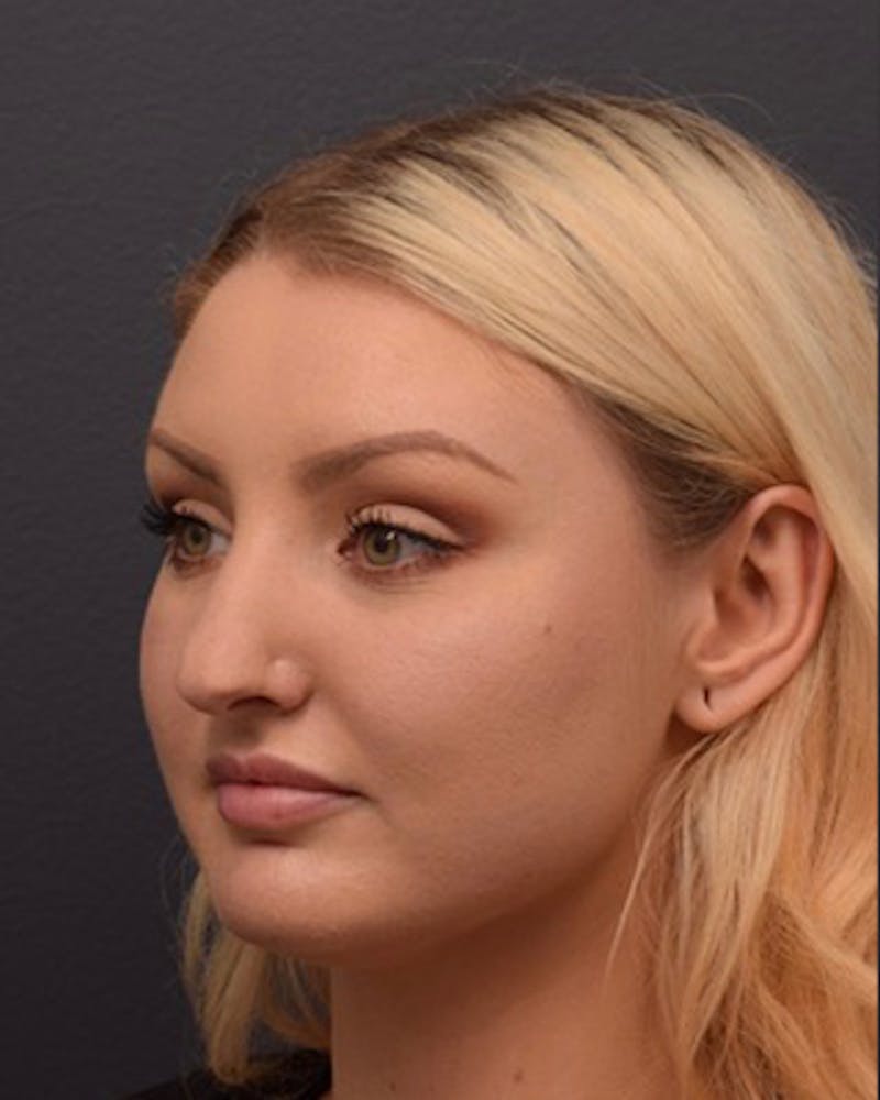 Ultrasonic Rhinoplasty Before & After Gallery - Patient 308011 - Image 7