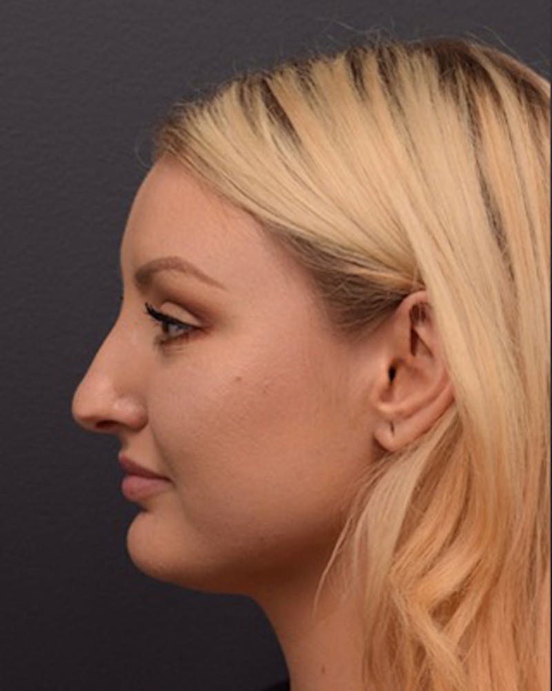 Ultrasonic Rhinoplasty Before & After Gallery - Patient 308011 - Image 9