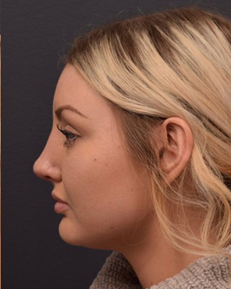 Ultrasonic Rhinoplasty Before & After Gallery - Patient 308011 - Image 10