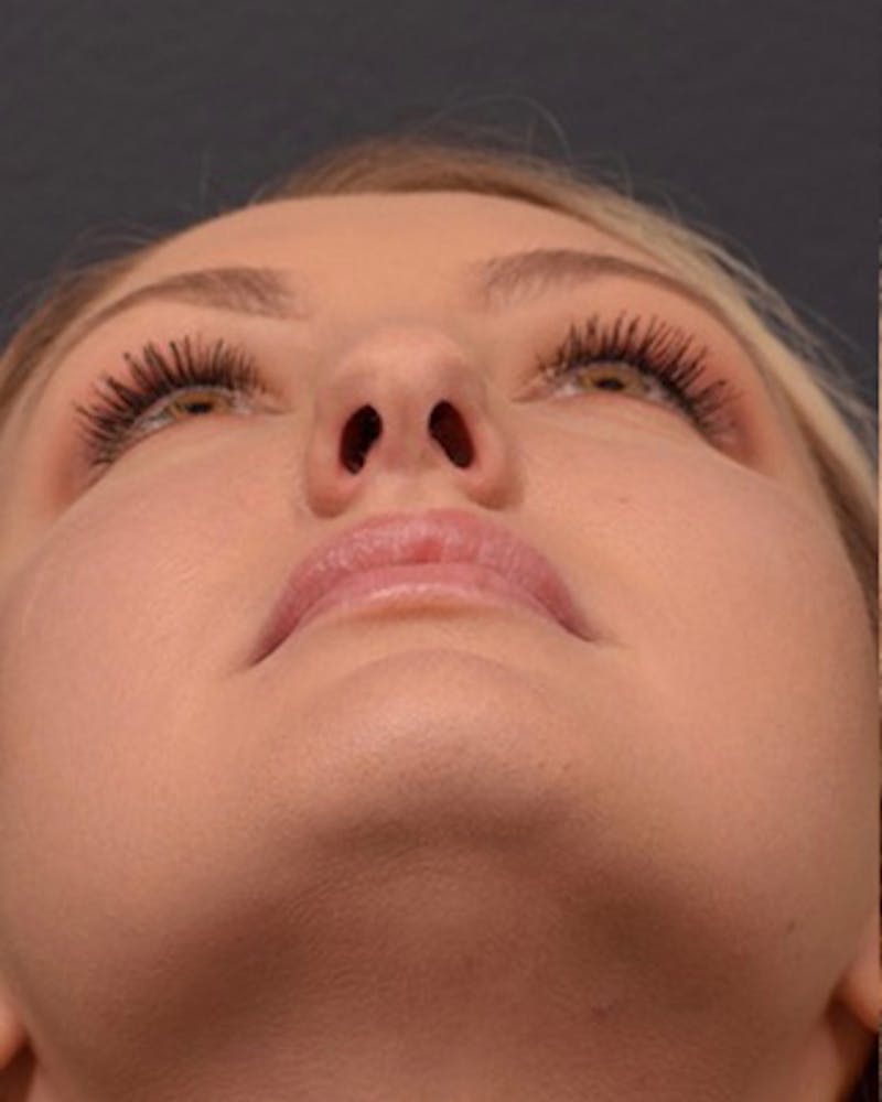 Ultrasonic Rhinoplasty Before & After Gallery - Patient 308011 - Image 11