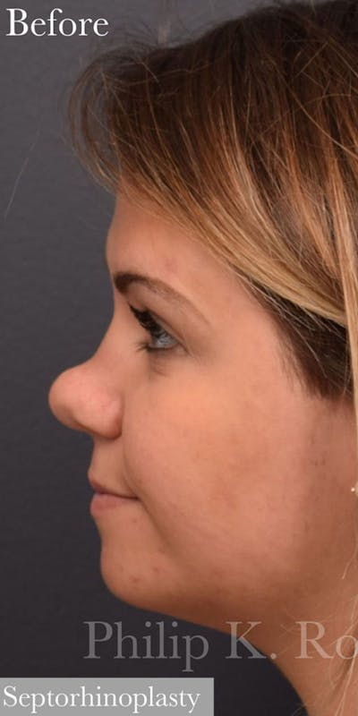 Ultrasonic Rhinoplasty Before & After Gallery - Patient 206570 - Image 1