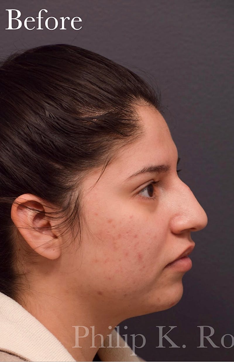 Ultrasonic Rhinoplasty Before & After Gallery - Patient 765893 - Image 1
