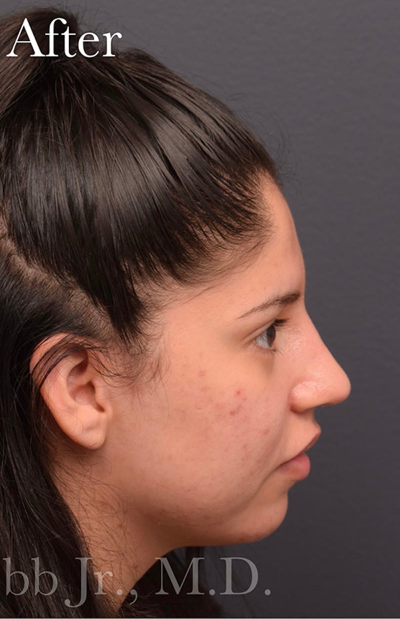 Ultrasonic Rhinoplasty Before & After Gallery - Patient 765893 - Image 2