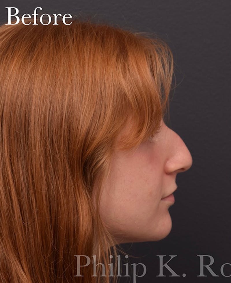 Ultrasonic Rhinoplasty Before & After Gallery - Patient 405301 - Image 1