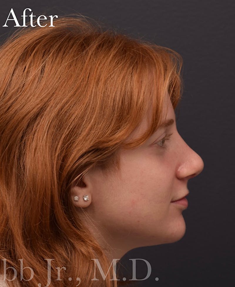 Ultrasonic Rhinoplasty Before & After Gallery - Patient 405301 - Image 2