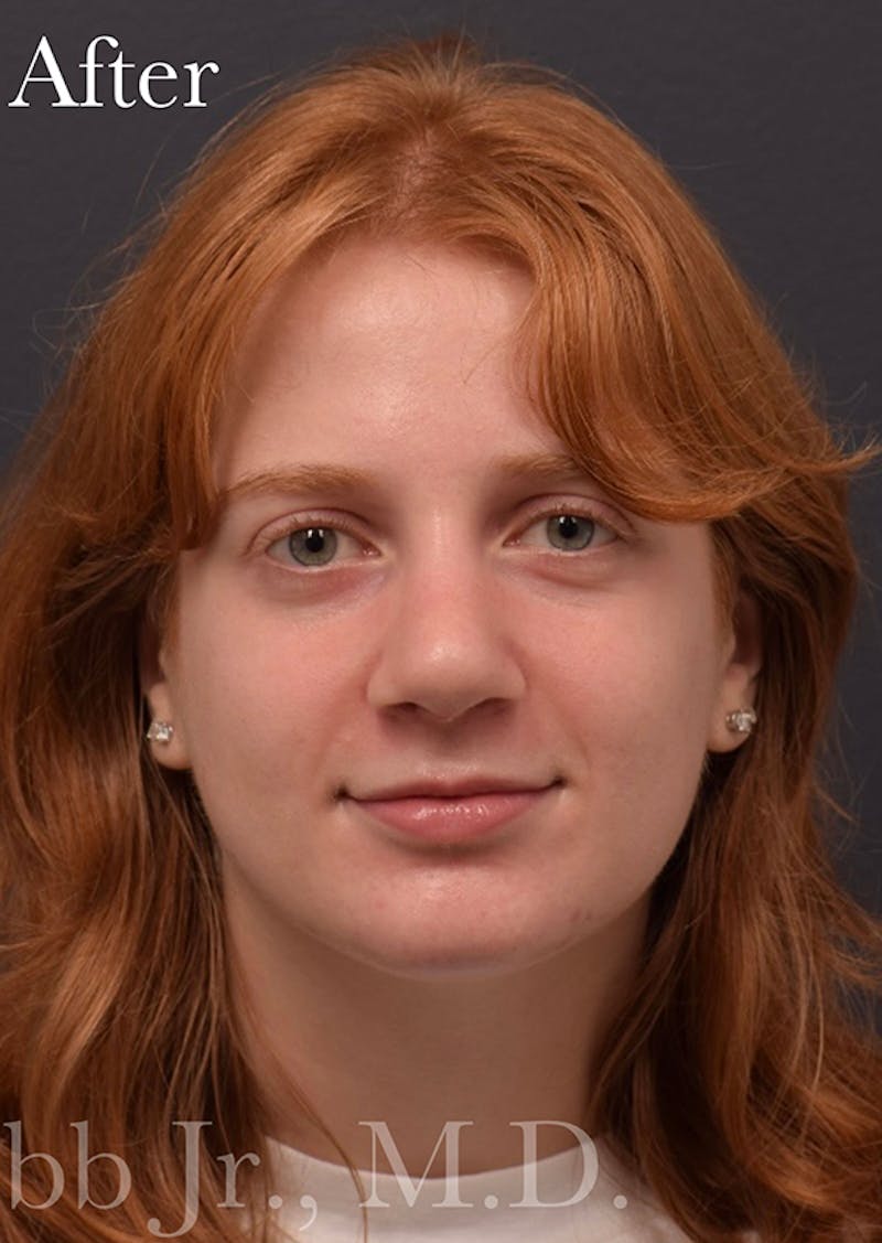 Ultrasonic Rhinoplasty Before & After Gallery - Patient 405301 - Image 4