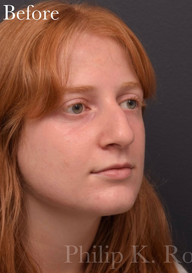 Ultrasonic Rhinoplasty Before & After Gallery - Patient 405301 - Image 5