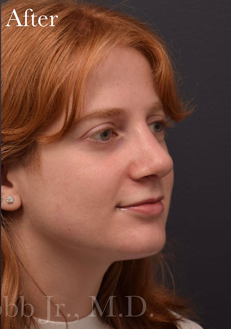 Ultrasonic Rhinoplasty Before & After Gallery - Patient 405301 - Image 6
