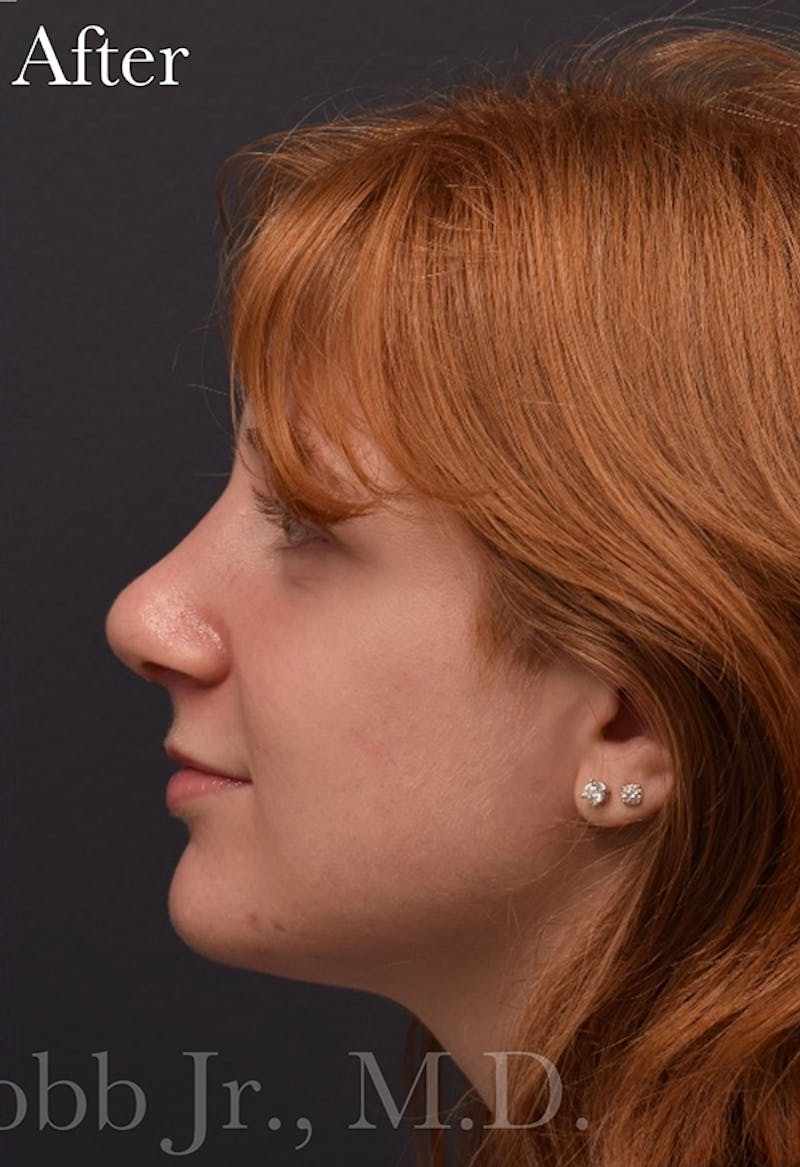 Ultrasonic Rhinoplasty Before & After Gallery - Patient 405301 - Image 8