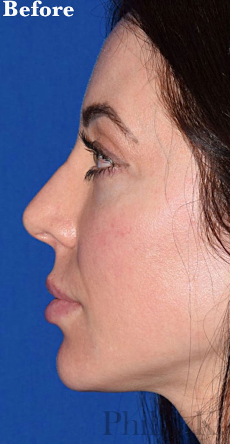 Ultrasonic Rhinoplasty Before & After Gallery - Patient 317748 - Image 1