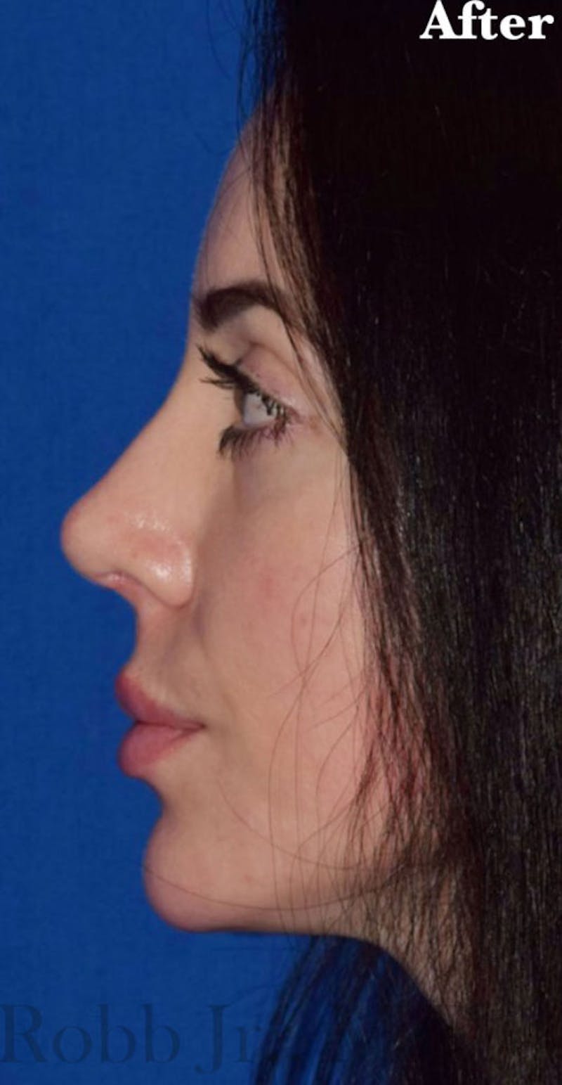 Ultrasonic Rhinoplasty Before & After Gallery - Patient 317748 - Image 2