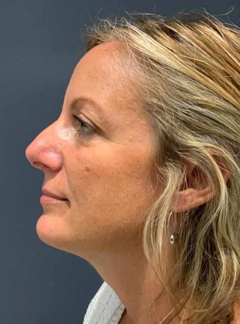 Ultrasonic Rhinoplasty Before & After Gallery - Patient 473501 - Image 1