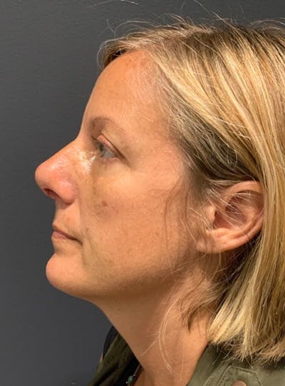 Ultrasonic Rhinoplasty Before & After Gallery - Patient 473501 - Image 2