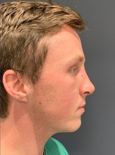 Ultrasonic Rhinoplasty Before & After Gallery - Patient 147582 - Image 2