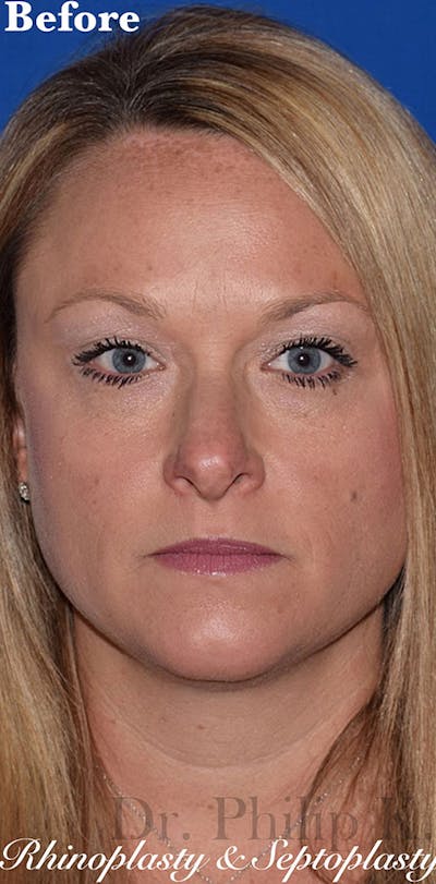 Ultrasonic Rhinoplasty Before & After Gallery - Patient 814852 - Image 1