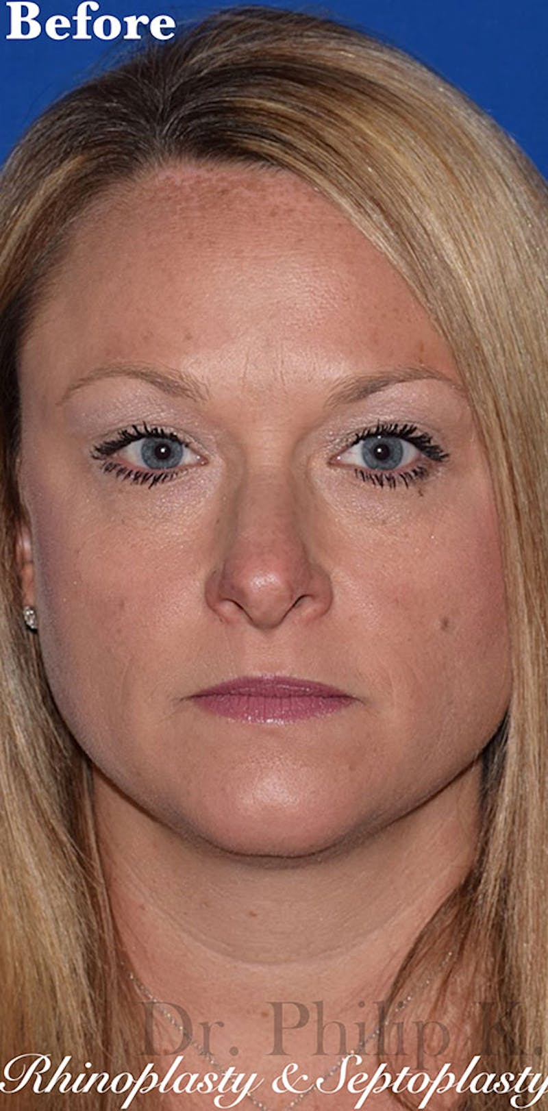 Ultrasonic Rhinoplasty Before & After Gallery - Patient 814852 - Image 1