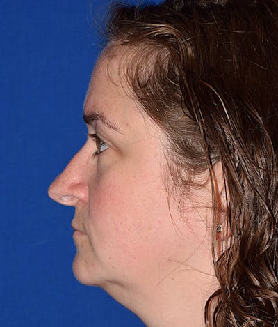 Ultrasonic Rhinoplasty Before & After Gallery - Patient 232497 - Image 1