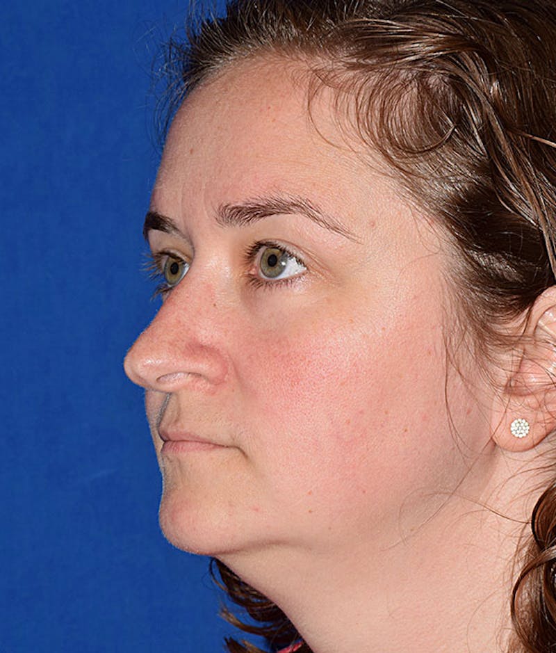 Ultrasonic Rhinoplasty Before & After Gallery - Patient 232497 - Image 3