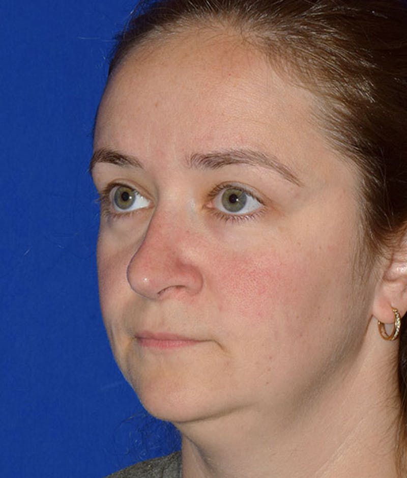 Ultrasonic Rhinoplasty Before & After Gallery - Patient 232497 - Image 4