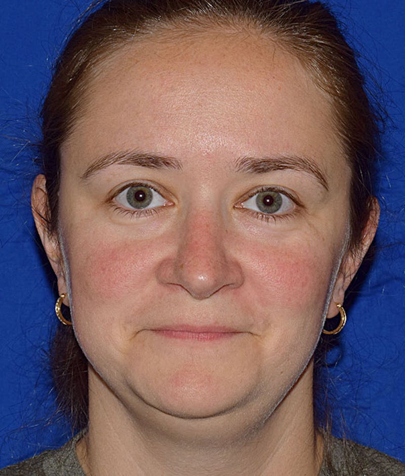 Ultrasonic Rhinoplasty Before & After Gallery - Patient 232497 - Image 6