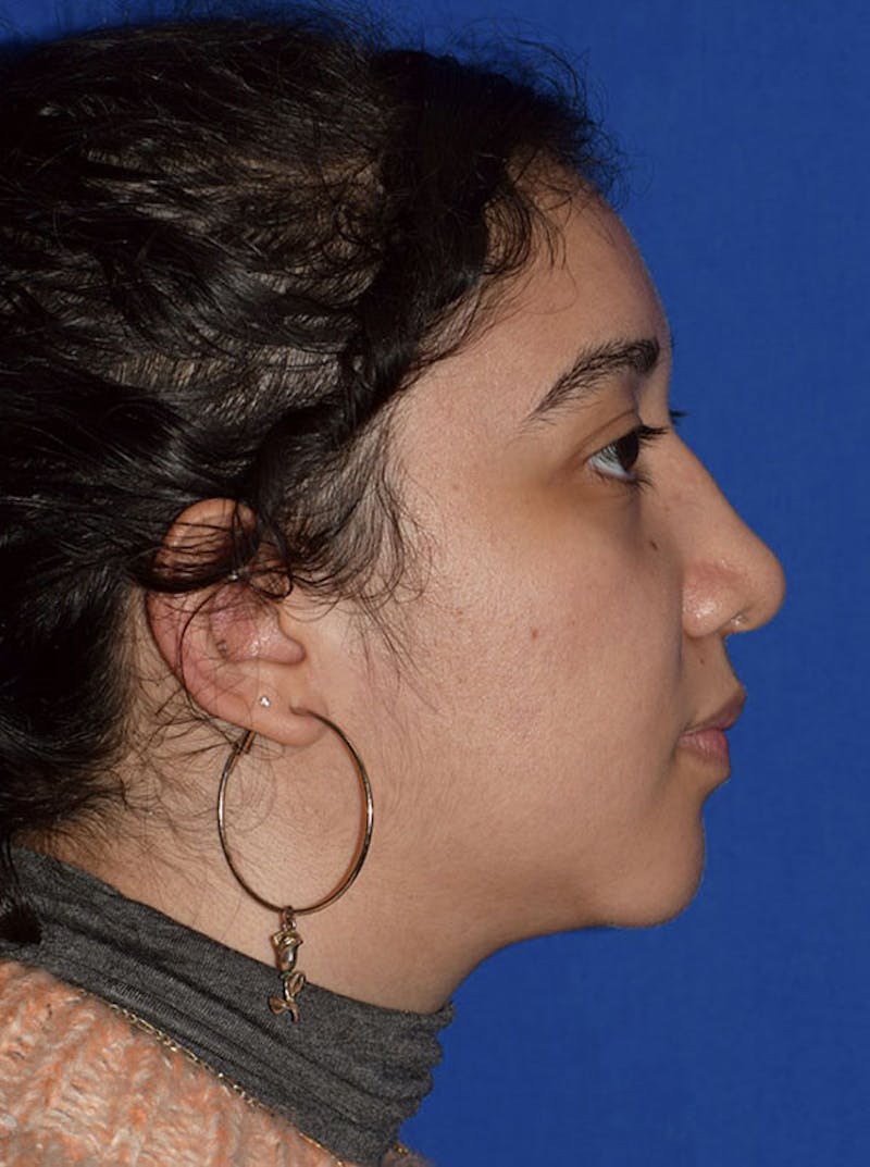 Ultrasonic Rhinoplasty Before & After Gallery - Patient 340843 - Image 2