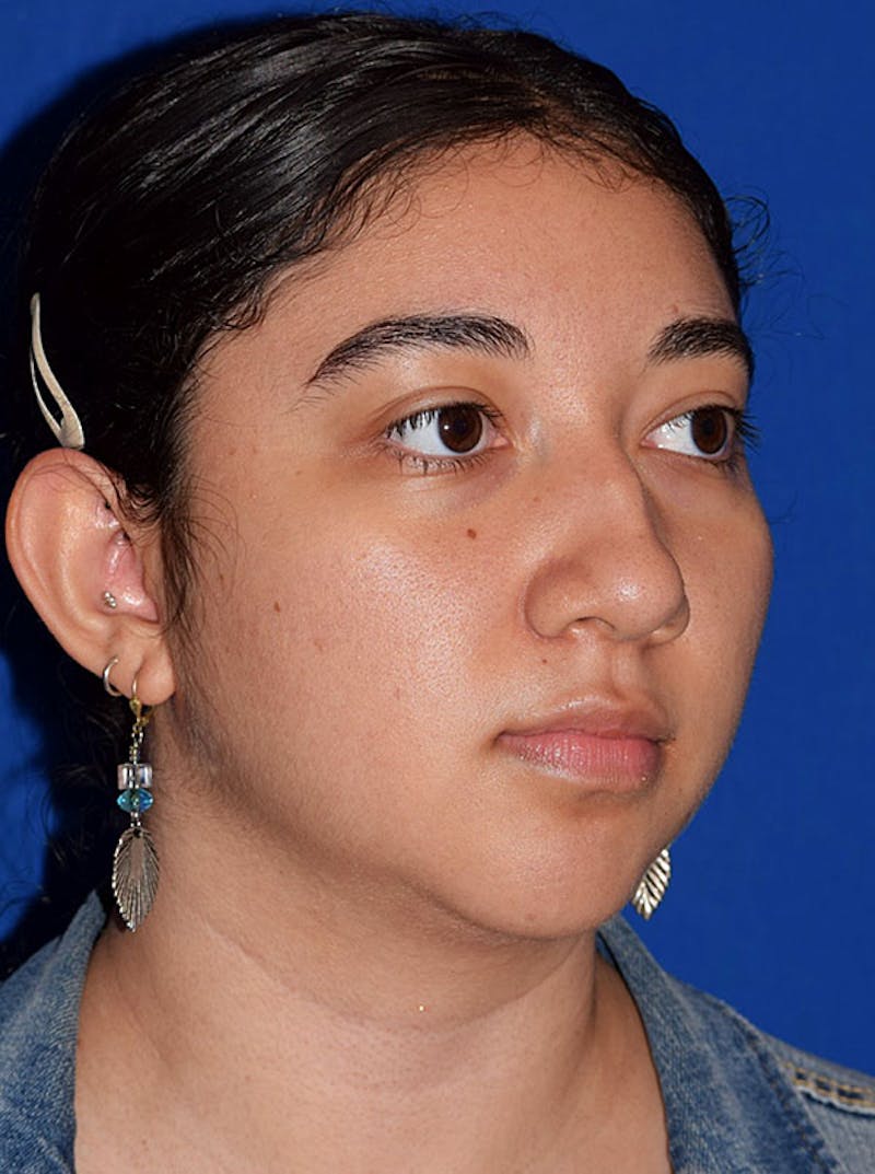 Ultrasonic Rhinoplasty Before & After Gallery - Patient 340843 - Image 3