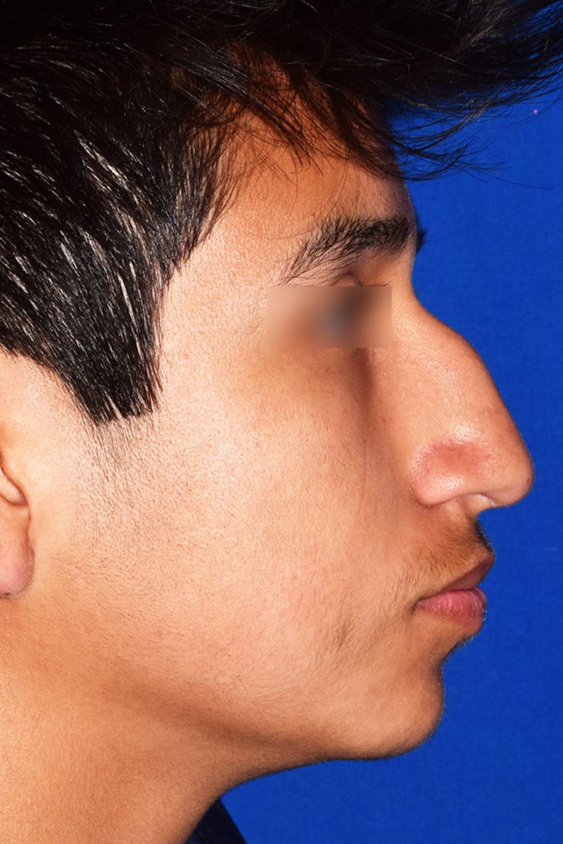 Ultrasonic Rhinoplasty Before & After Gallery - Patient 102770 - Image 1