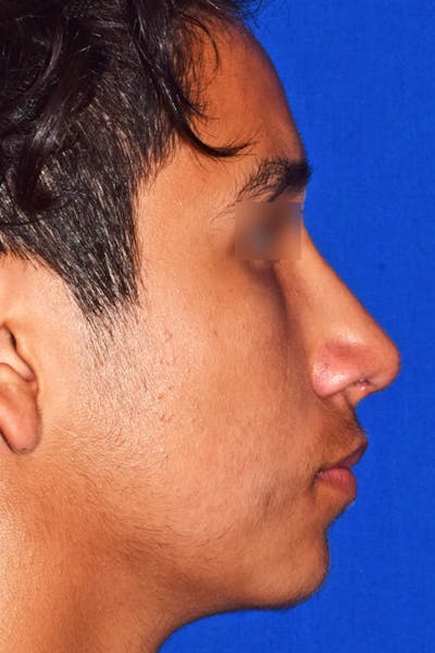 Ultrasonic Rhinoplasty Before & After Gallery - Patient 102770 - Image 2