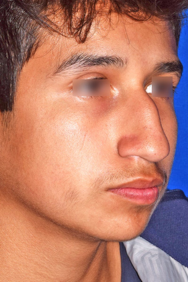 Ultrasonic Rhinoplasty Before & After Gallery - Patient 102770 - Image 3