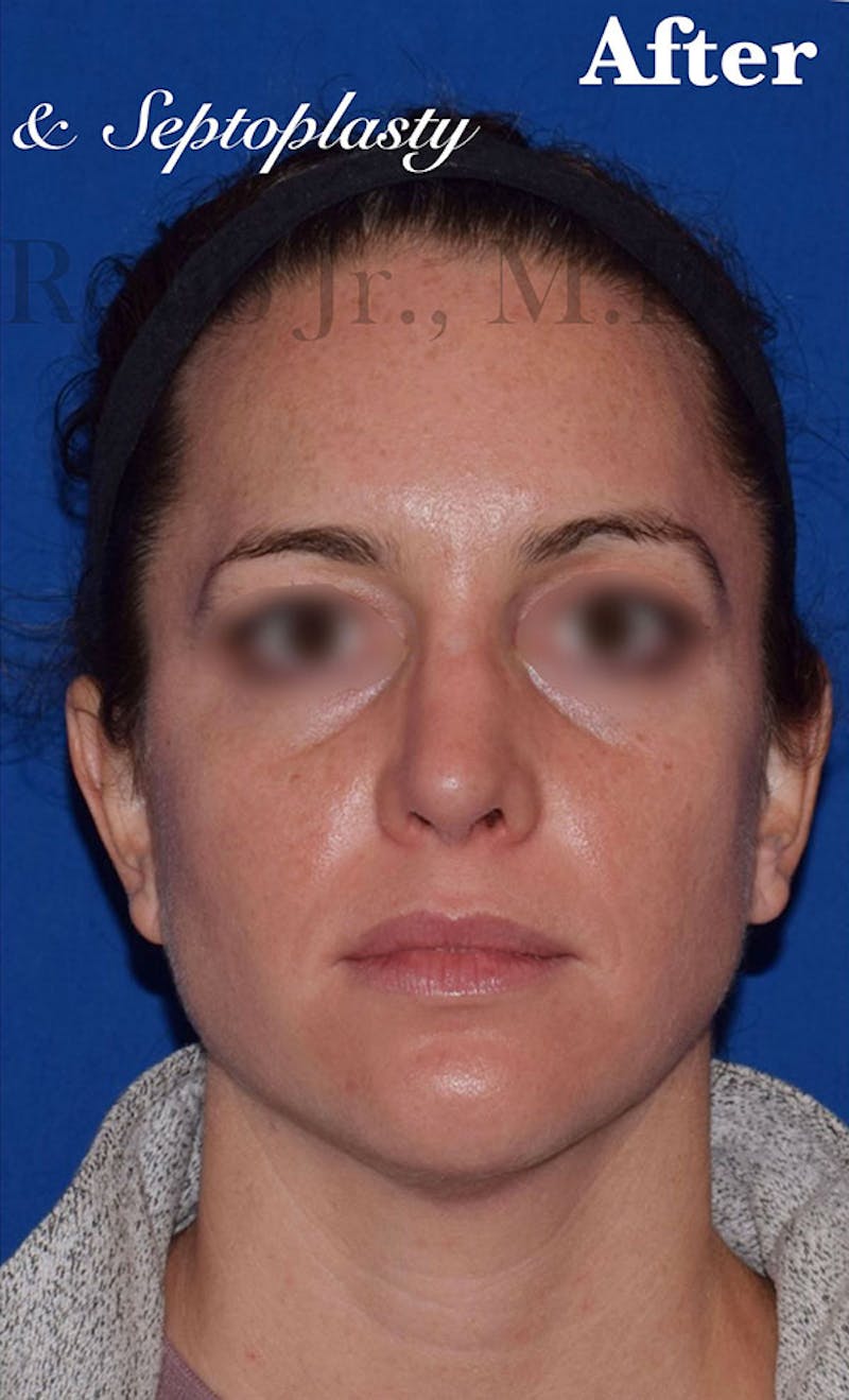 Ultrasonic Rhinoplasty Before & After Gallery - Patient 746075 - Image 2