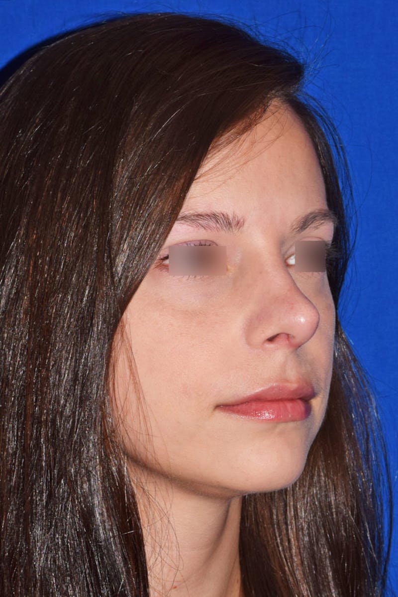 Ultrasonic Rhinoplasty Before & After Gallery - Patient 258663 - Image 4