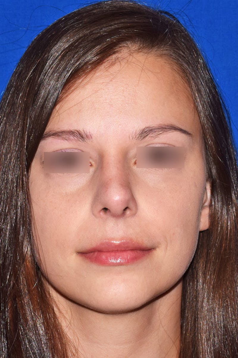 Ultrasonic Rhinoplasty Before & After Gallery - Patient 258663 - Image 6