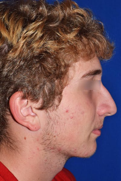 Ultrasonic Rhinoplasty Before & After Gallery - Patient 292692 - Image 1