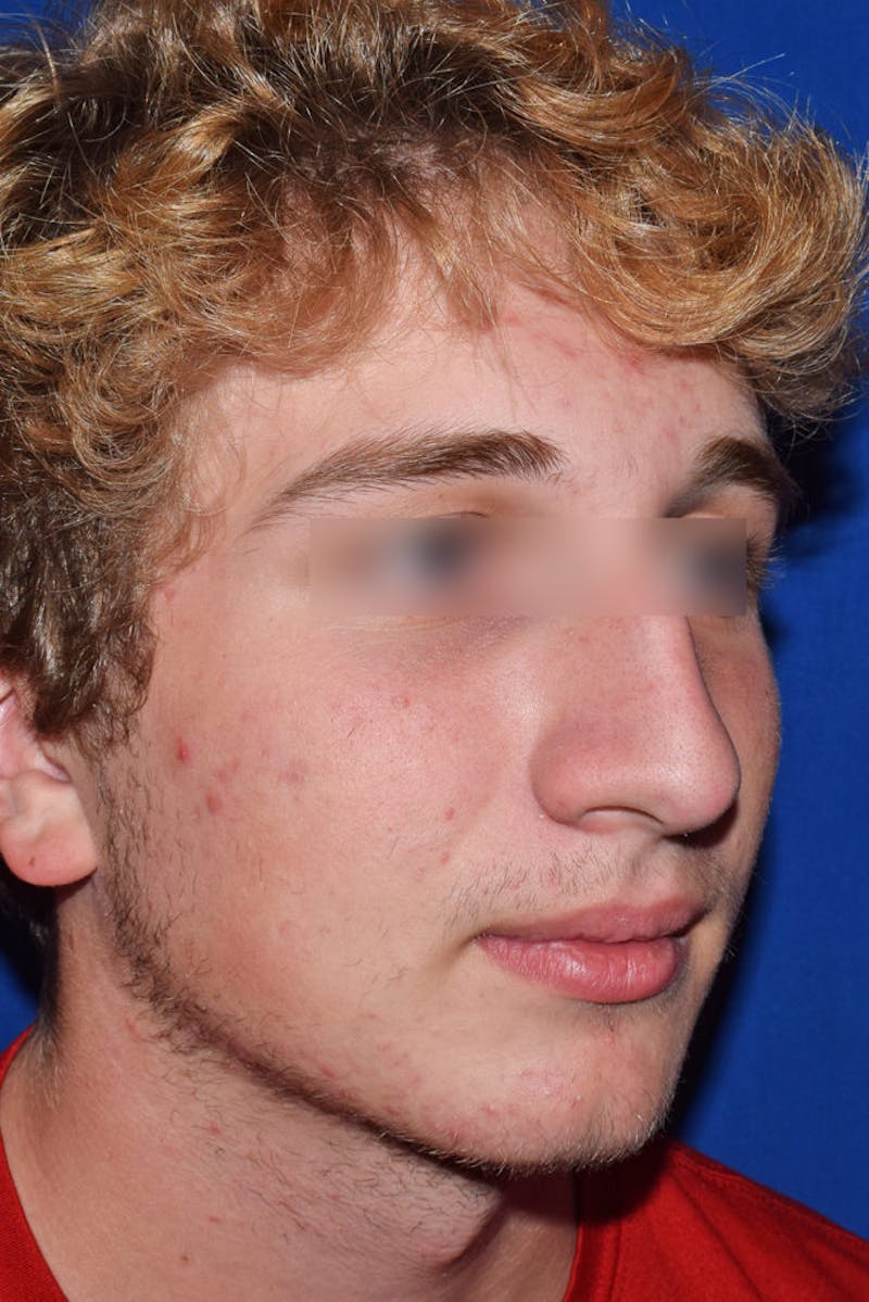 Ultrasonic Rhinoplasty Before & After Gallery - Patient 292692 - Image 3