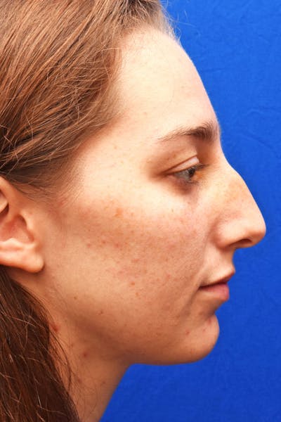 Ultrasonic Rhinoplasty Before & After Gallery - Patient 361512 - Image 1
