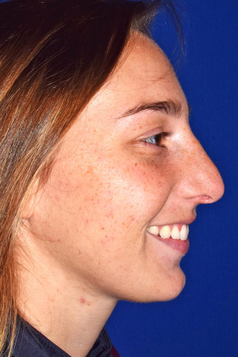Ultrasonic Rhinoplasty Before & After Gallery - Patient 361512 - Image 2