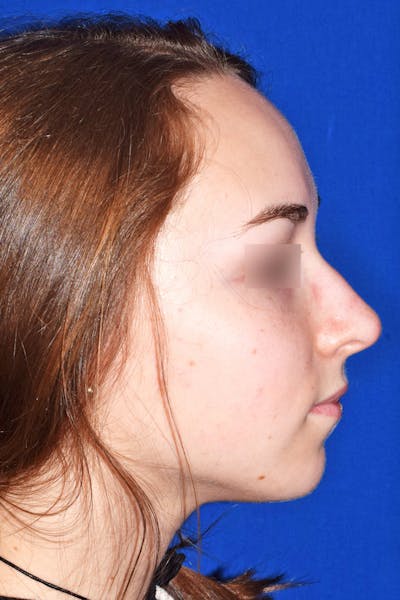 Ultrasonic Rhinoplasty Before & After Gallery - Patient 133279 - Image 1
