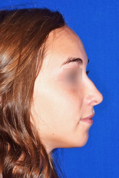 Ultrasonic Rhinoplasty Before & After Gallery - Patient 133279 - Image 2
