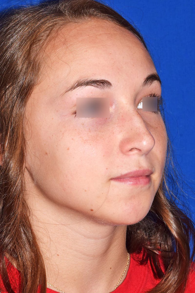 Ultrasonic Rhinoplasty Before & After Gallery - Patient 133279 - Image 4