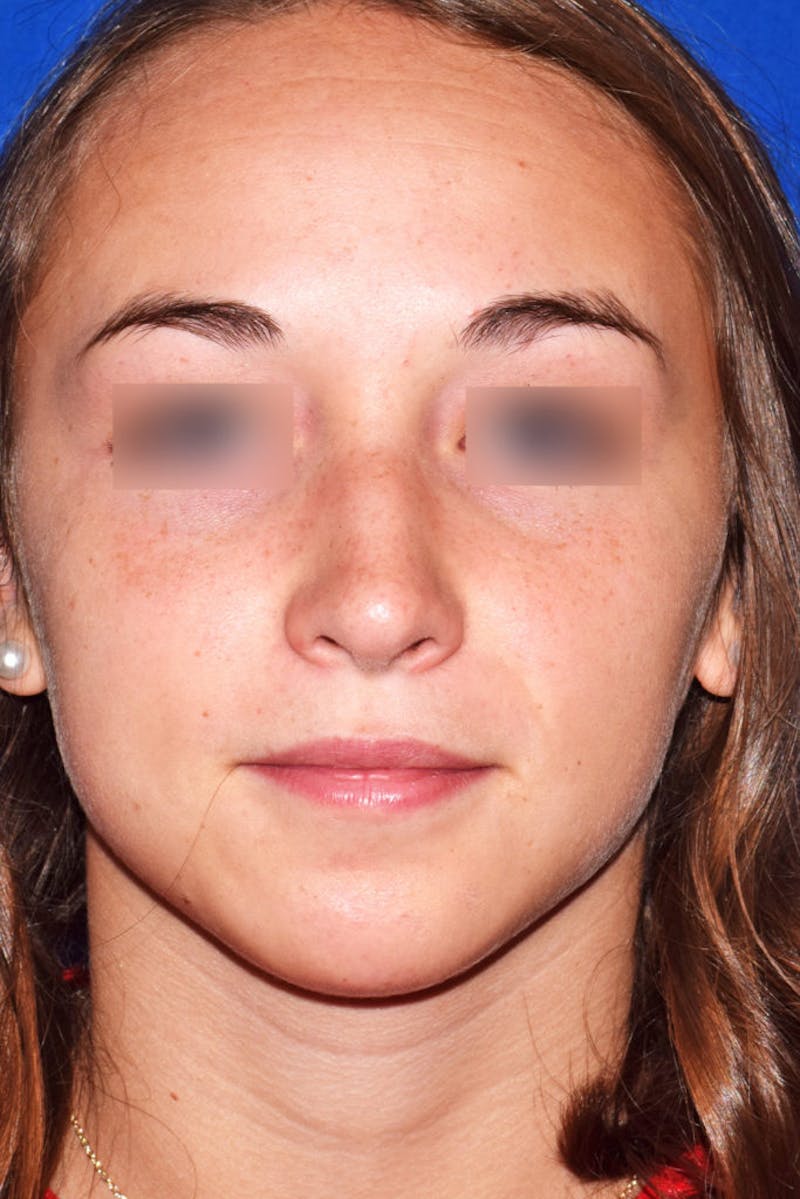 Ultrasonic Rhinoplasty Before & After Gallery - Patient 133279 - Image 6