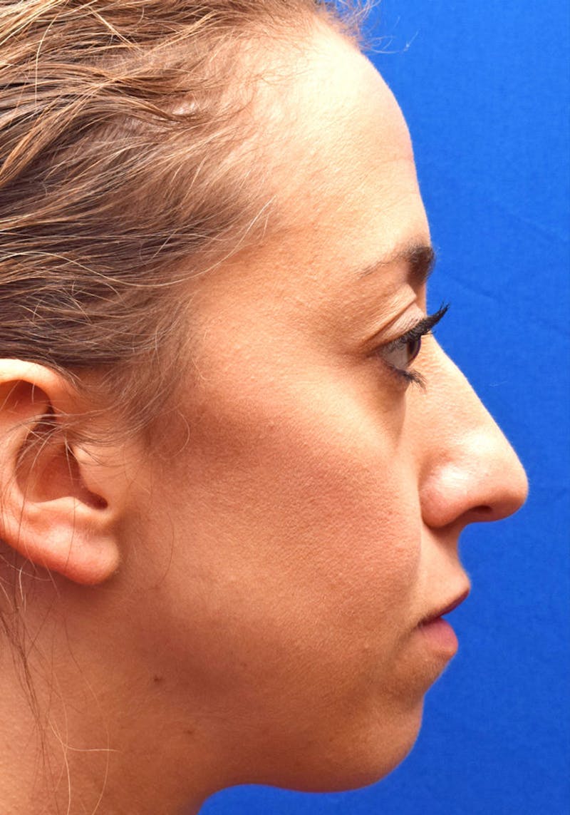 Ultrasonic Rhinoplasty Before & After Gallery - Patient 268516 - Image 1