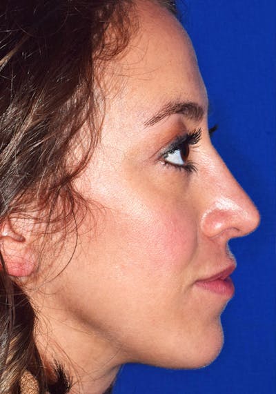 Ultrasonic Rhinoplasty Before & After Gallery - Patient 268516 - Image 2