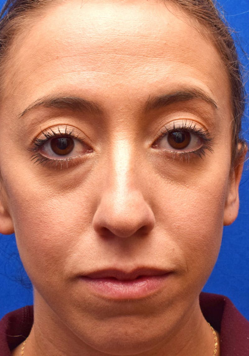 Ultrasonic Rhinoplasty Before & After Gallery - Patient 268516 - Image 5