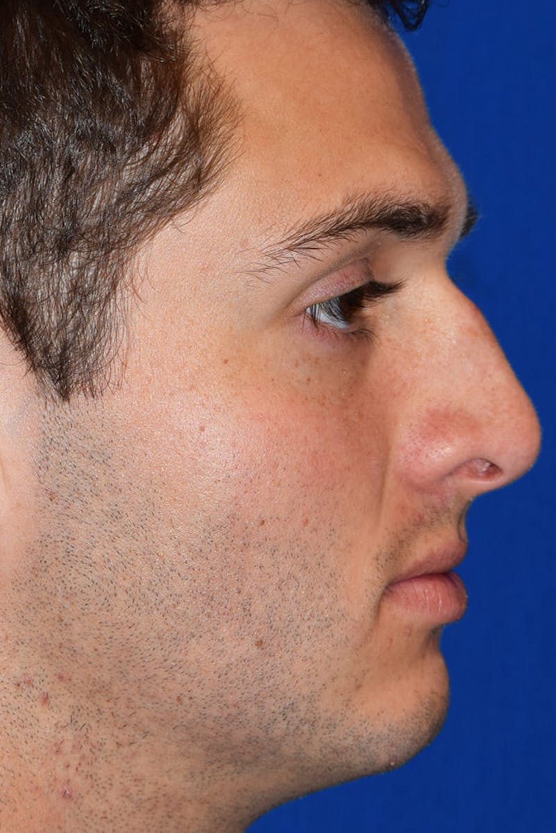 Ultrasonic Rhinoplasty Before & After Gallery - Patient 272192 - Image 1
