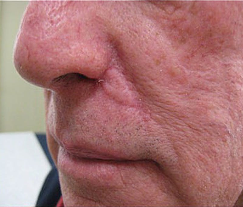 Facial Reconstruction Before & After Gallery - Patient 338905 - Image 2