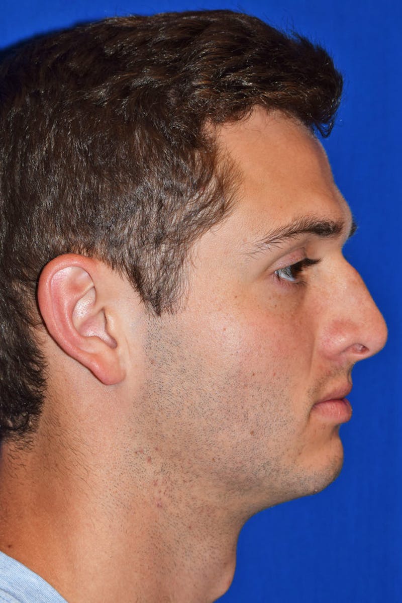 Ultrasonic Rhinoplasty Before & After Gallery - Patient 272192 - Image 3