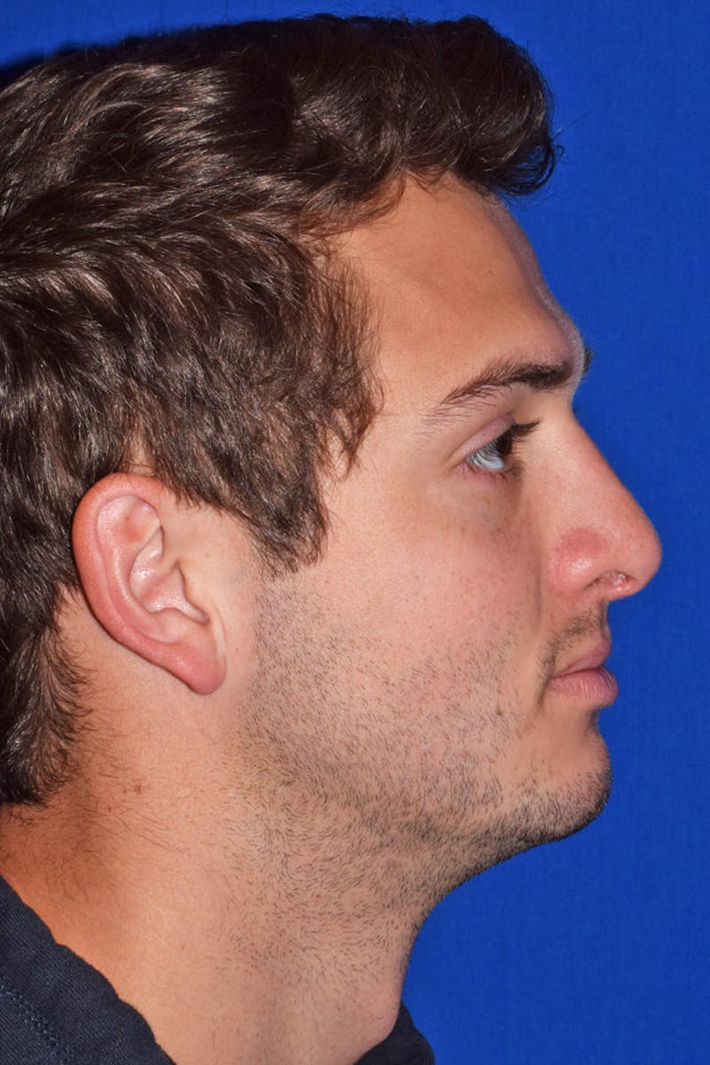 Ultrasonic Rhinoplasty Before & After Gallery - Patient 272192 - Image 4